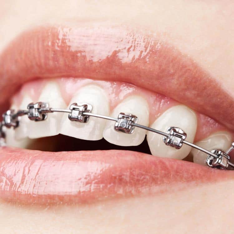 Traditional Metal or Clear Braces Braces for Adults