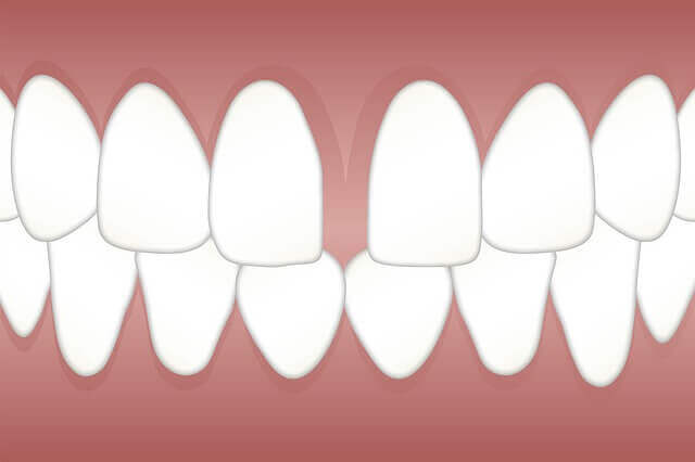 Fixing Gaps in Teeth